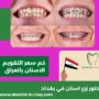 كم سعر التقويم الاسنان بالعراق