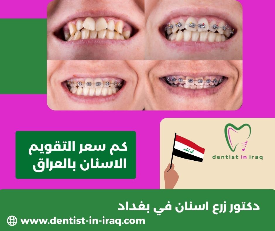 كم سعر التقويم الاسنان بالعراق