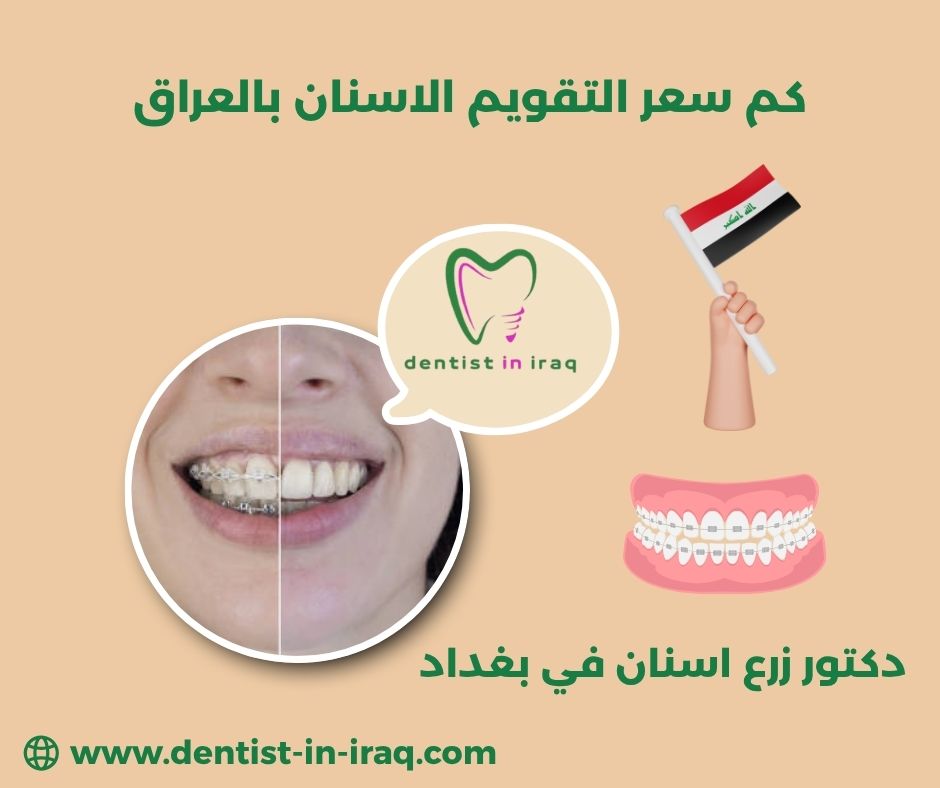 كم سعر التقويم الاسنان بالعراق كم سعر التقويم الاسنان بالعراق