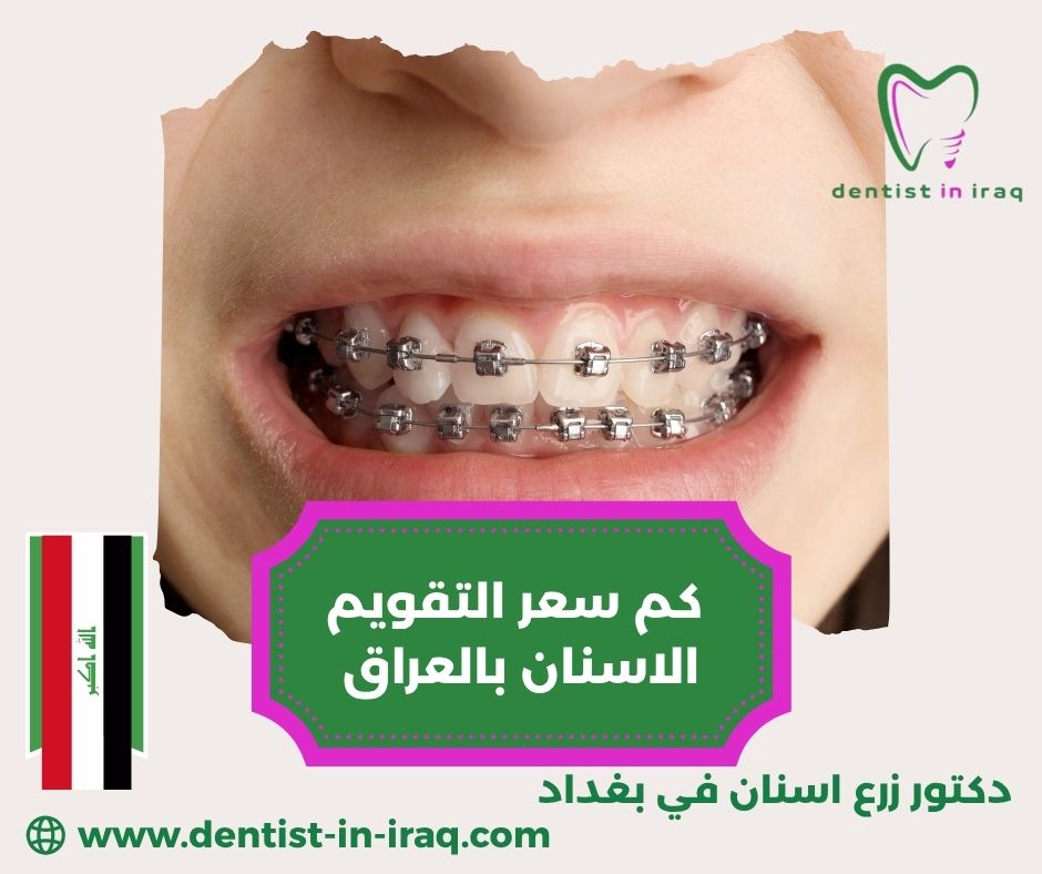 كم تكلفة زراعة السن الواحد في بغداد كم تكلفة زراعة السن الواحد في بغداد