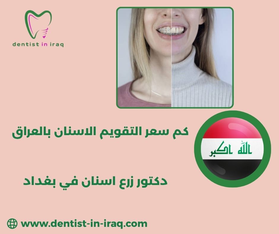 سعر تقويم الاسنان العراق سعر تقويم الاسنان العراق