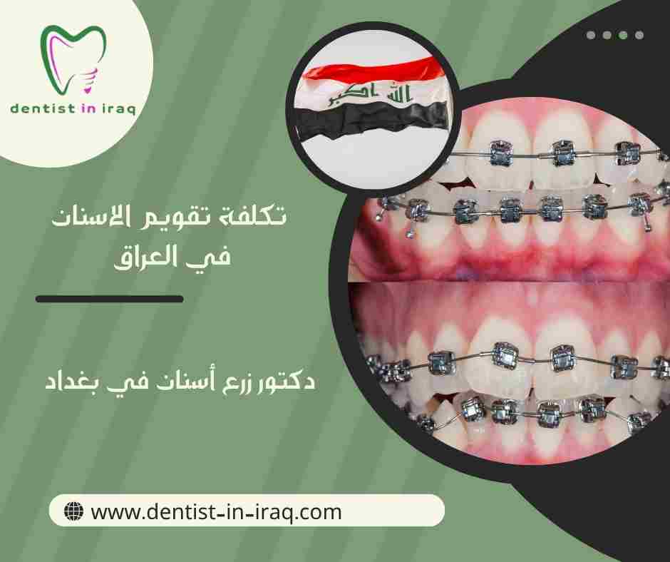 تكلفة تقويم الاسنان في العراق
