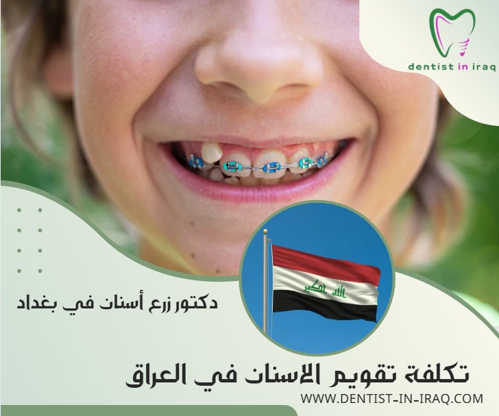 تكلفة تقويم الاسنان في العراق