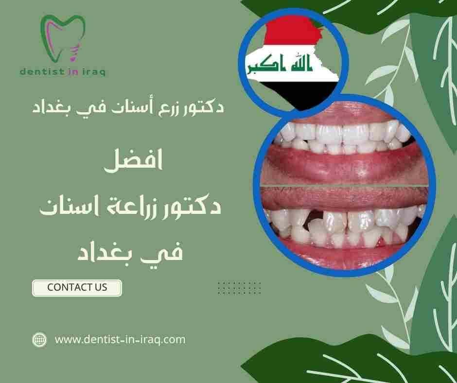 افضل دكتور زراعة اسنان في بغداد