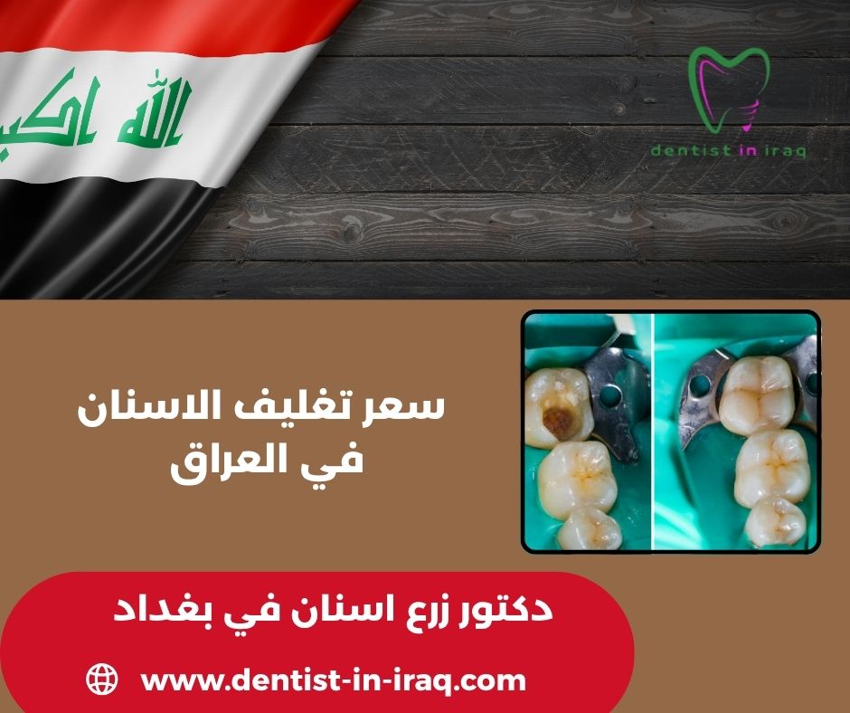 سعر تغليف الاسنان في العراق