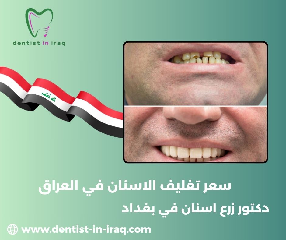 اسعار اسنان الزيركون في العراق اسعار اسنان الزيركون في العراق