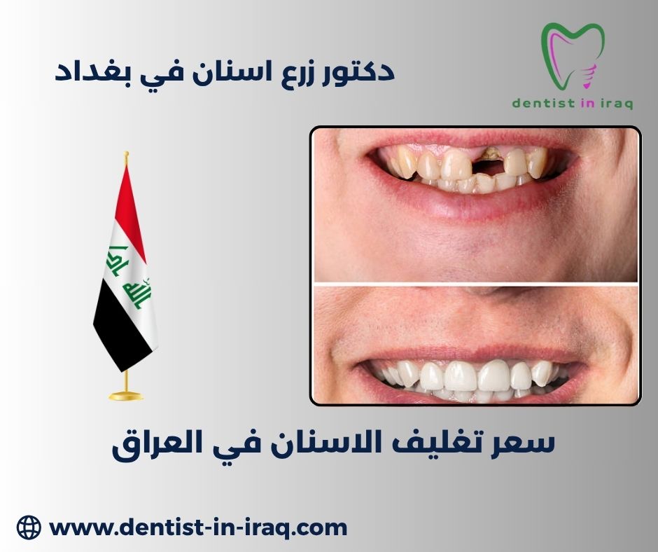 سعر حشوة الأسنان الدائمة في العراق سعر حشوة الأسنان الدائمة في العراق