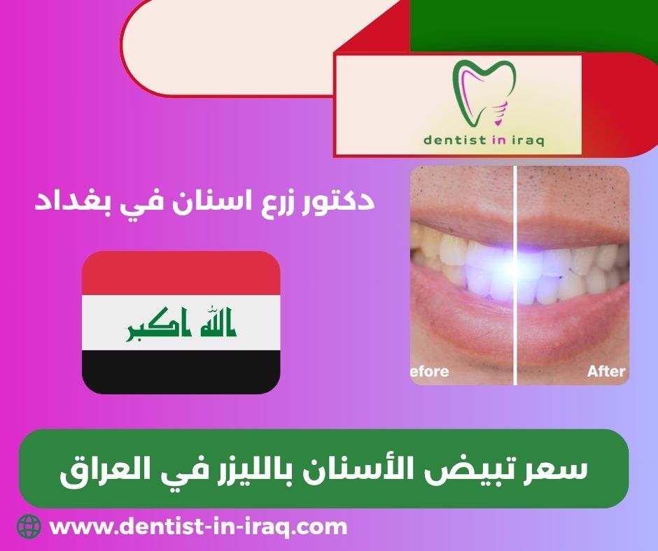أسعار تبيض الاسنان بالليزر في العراق أسعار تبيض الاسنان بالليزر في العراق