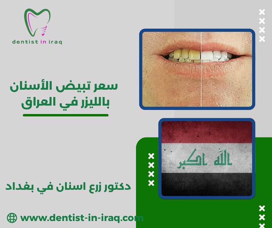 أنواع تبيض الأسنان واسعارها في العراق  أنواع تبيض الأسنان واسعارها في العراق