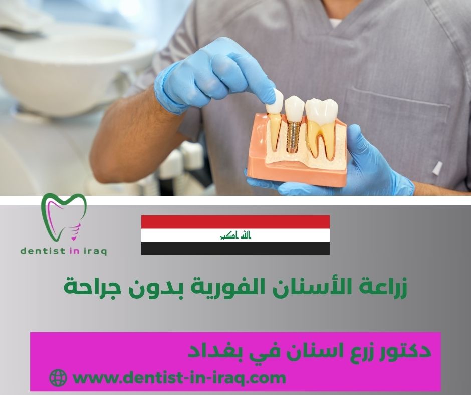 زراعة الأسنان الفورية بدون جراحة زراعة الأسنان الفورية بدون جراحة