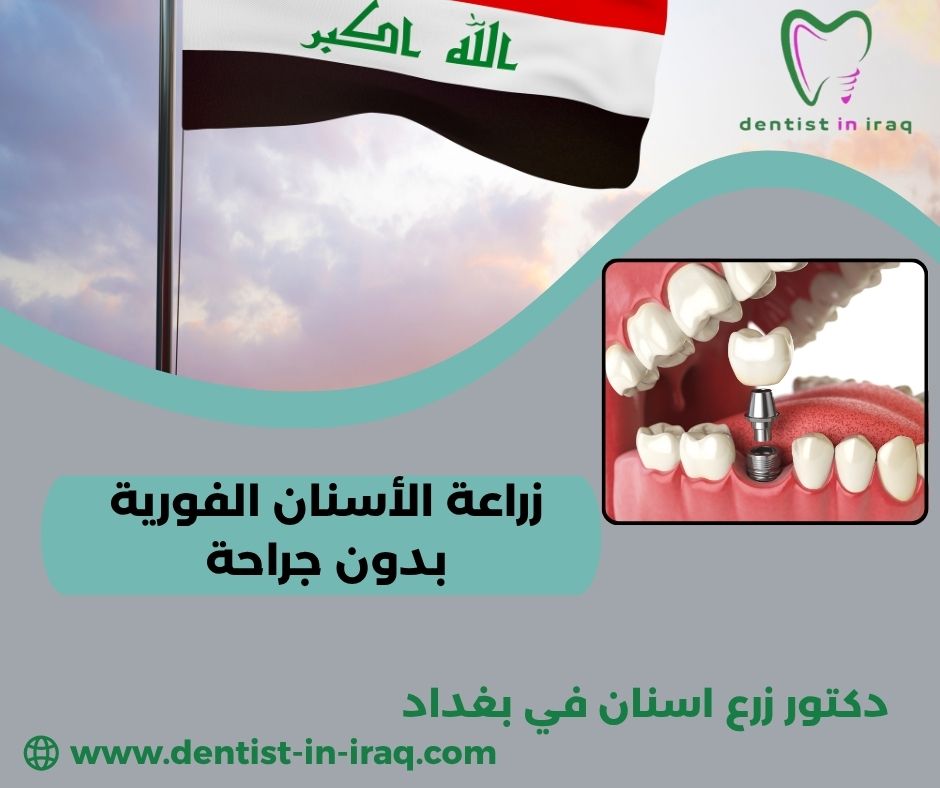 زراعة الأسنان بدون فتح لثة زراعة الأسنان بدون فتح لثة