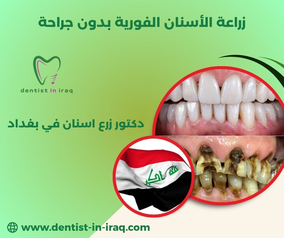 زراعة الأسنان الفورية في العراق زراعة الأسنان الفورية في العراق