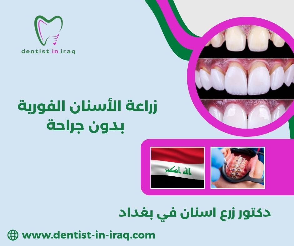 زراعة الأسنان الفورية بدون جراحة