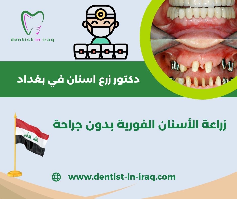 زراعة الأسنان بدون عملية جراحية زراعة الأسنان بدون عملية جراحية