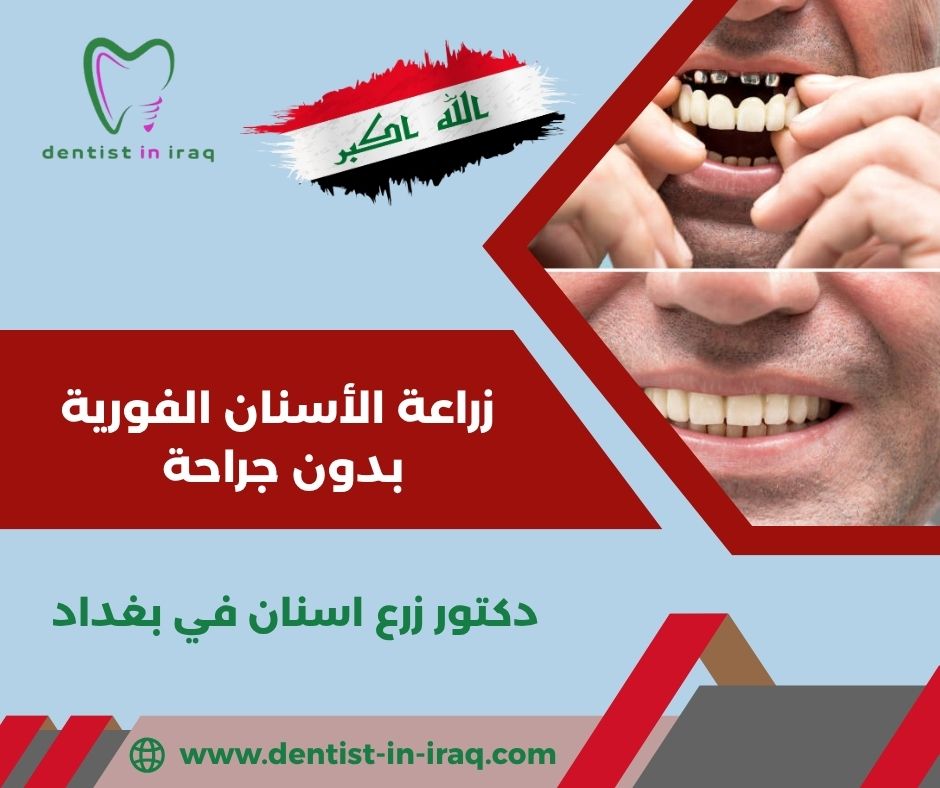 زراعة الأسنان الفورية في بغداد زراعة الأسنان الفورية في بغداد