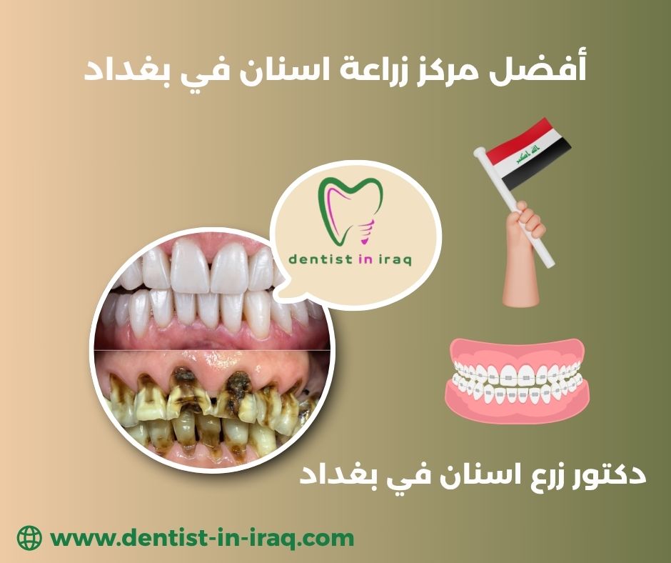 كم تكلفة زراعة الاسنان في العراق