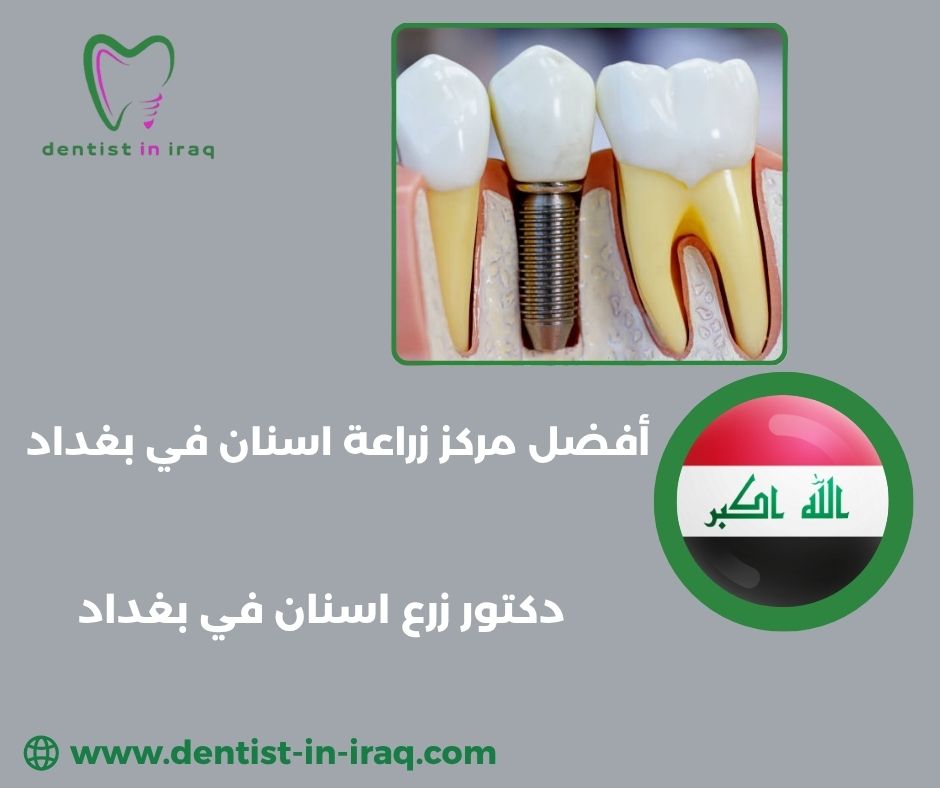 اسعار زراعة الاسنان في بغداد