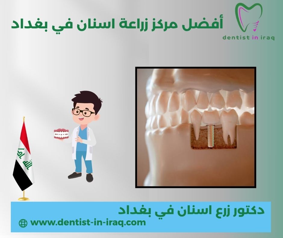 أفضل مركز زراعة اسنان في بغداد