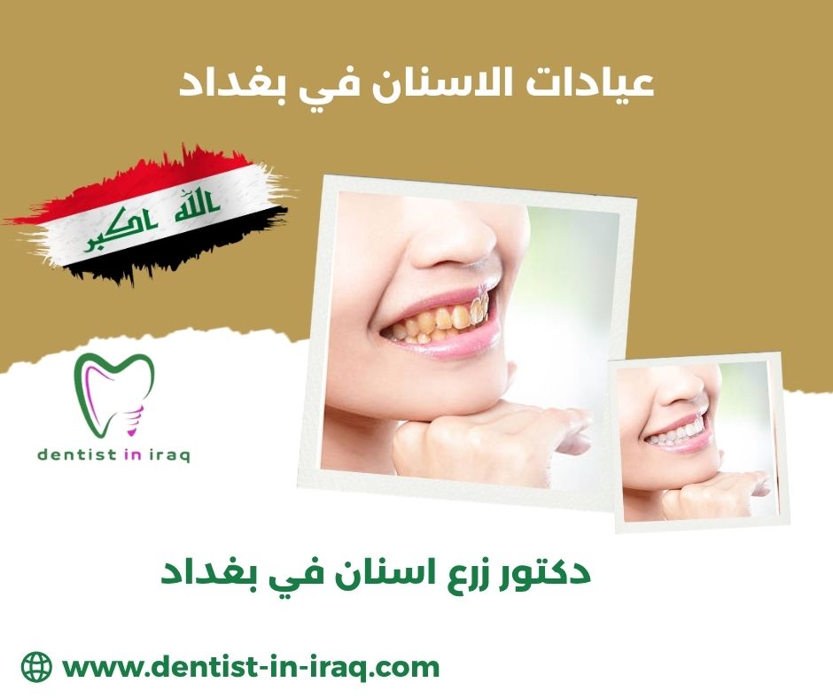 عيادات زراعة الاسنان في بغداد