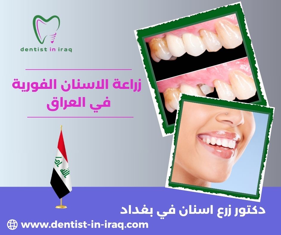 زراعة الاسنان الفورية في العراق