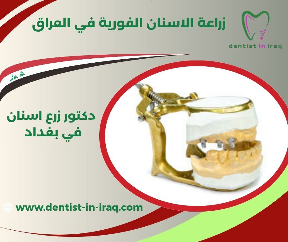 زراعة الأسنان في جلسة واحدة زراعة الأسنان في جلسة واحدة