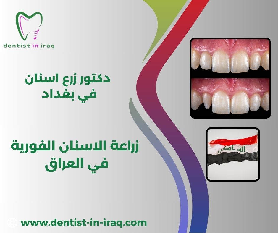 عيوب زراعة الأسنان الفورية عيوب زراعة الأسنان الفورية
