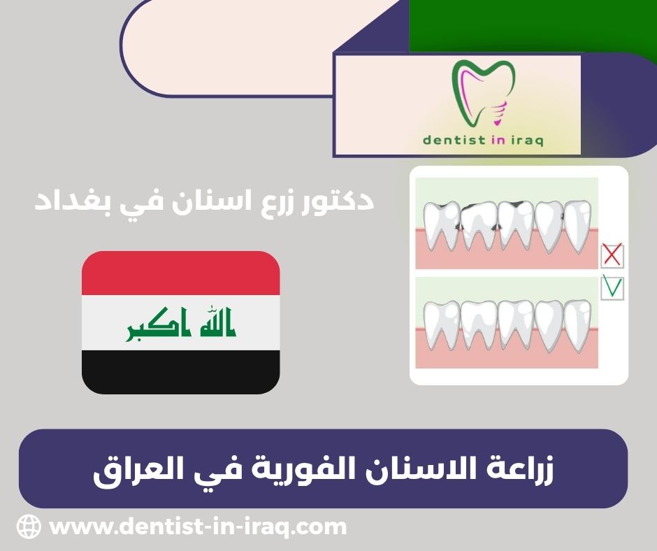 أفضل طبيب زراعة اسنان في بغداد أفضل طبيب زراعة اسنان في بغداد