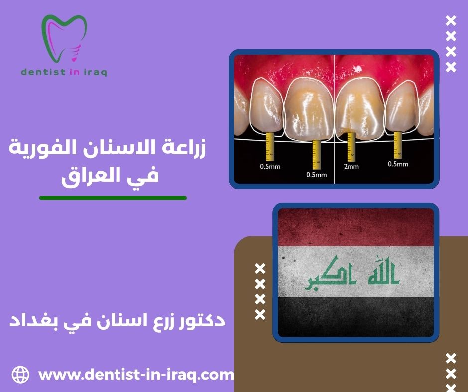 زراعة الاسنان الفورية في العراق زراعة الاسنان الفورية في العراق