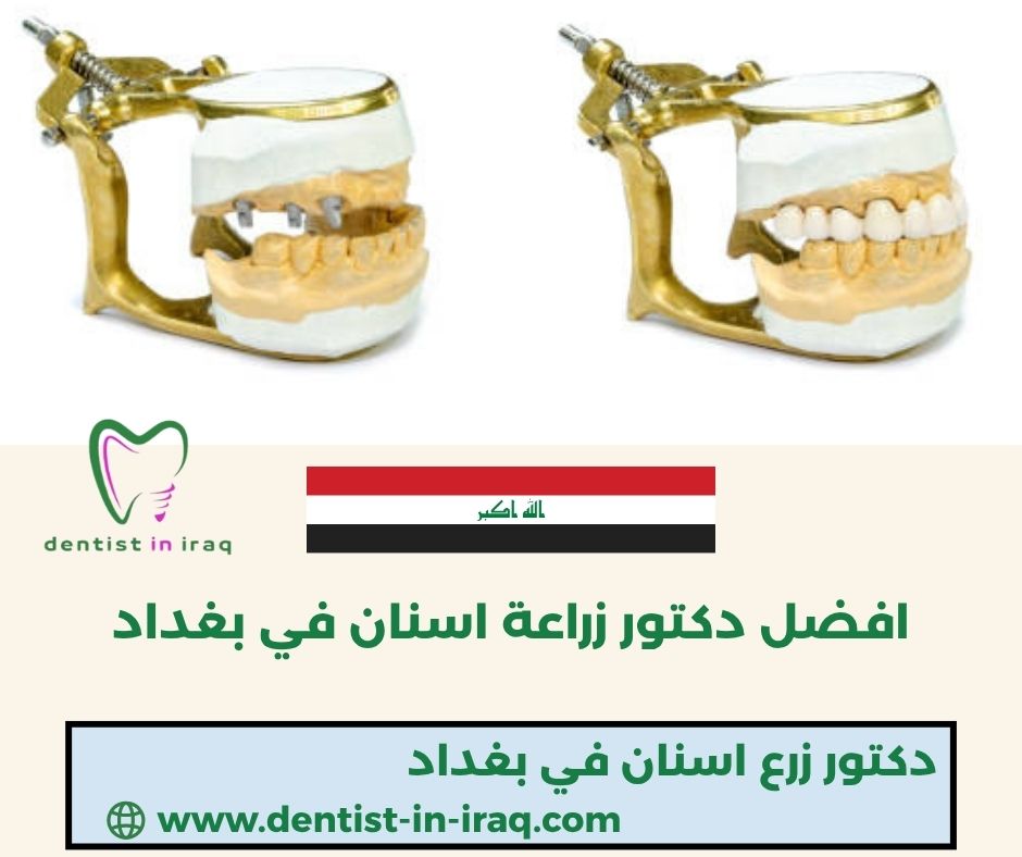 مركز زراعة الاسنان في بغداد