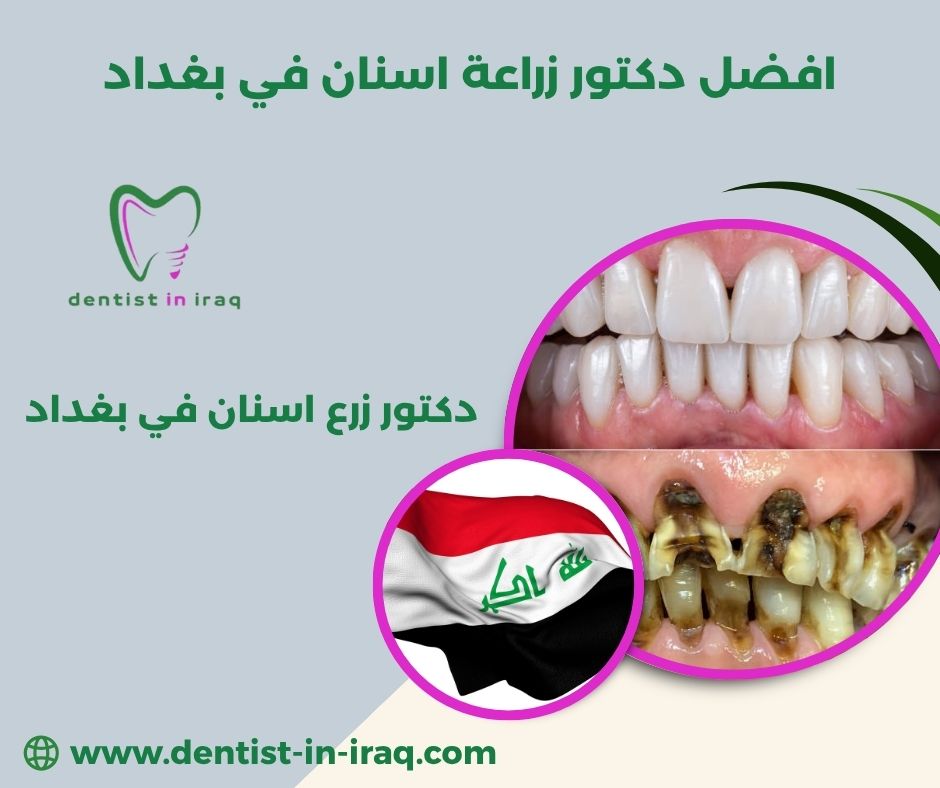 زراعة الأسنان في العراق