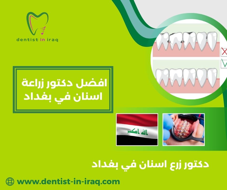 أسعار زراعة الأسنان في بغداد