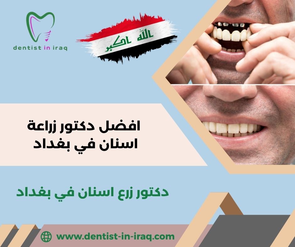 افضل دكتور زراعة اسنان في بغداد