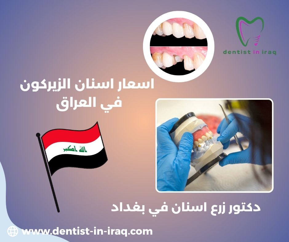 سعر حشوة الأسنان الدائمة في العراق