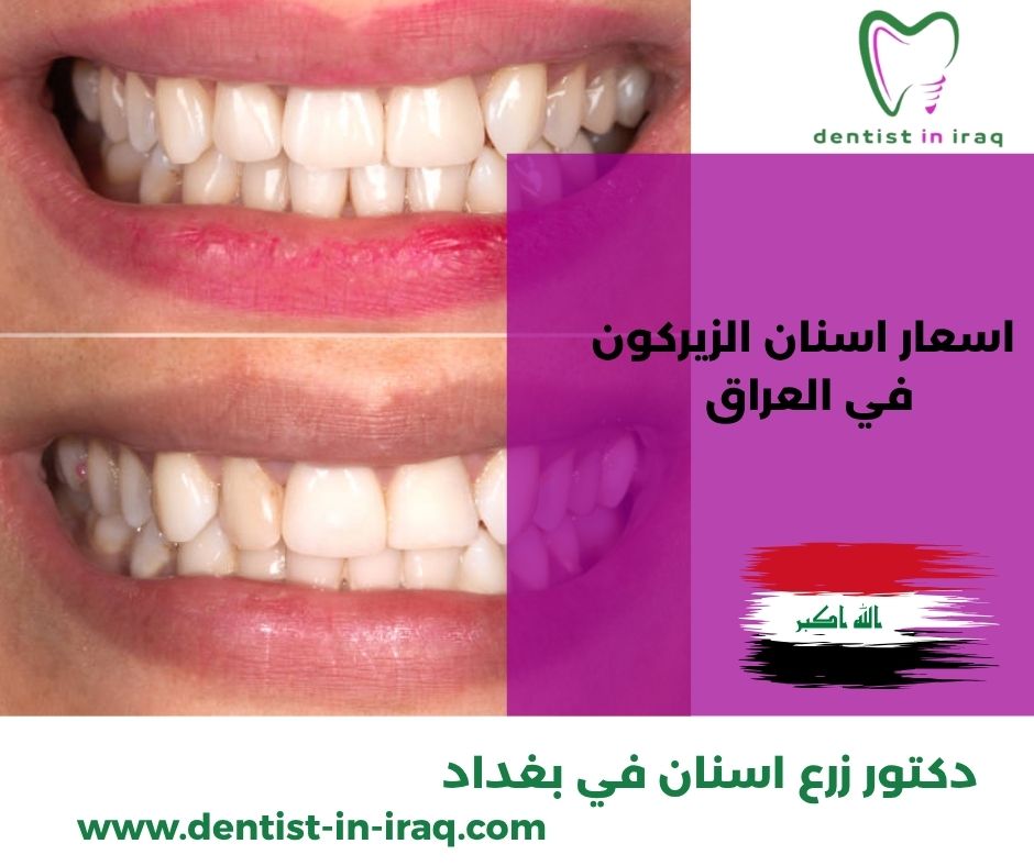 سعر تغليف الاسنان في العراق