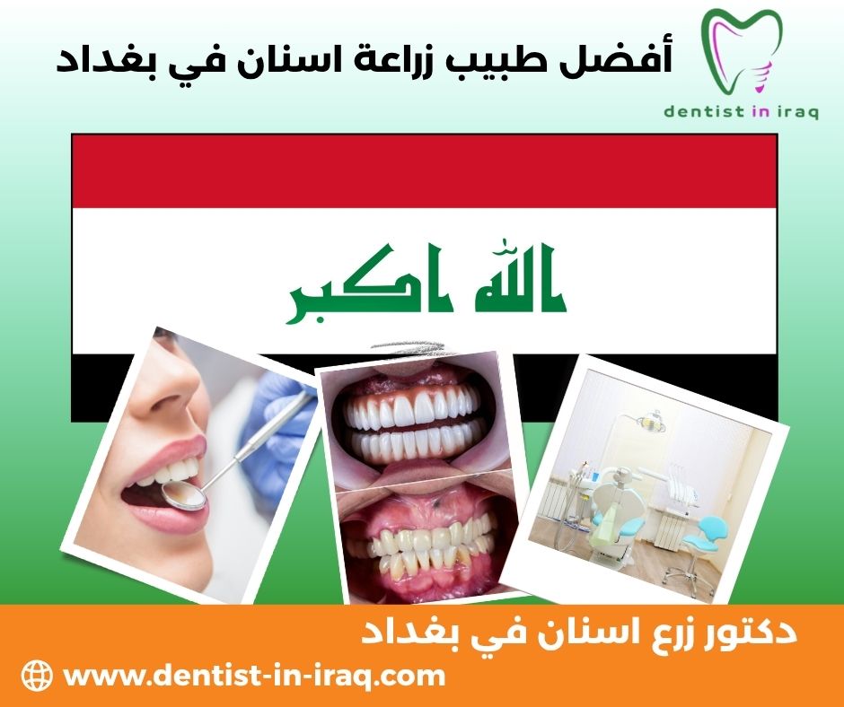 أفضل طبيب زراعة اسنان في بغداد