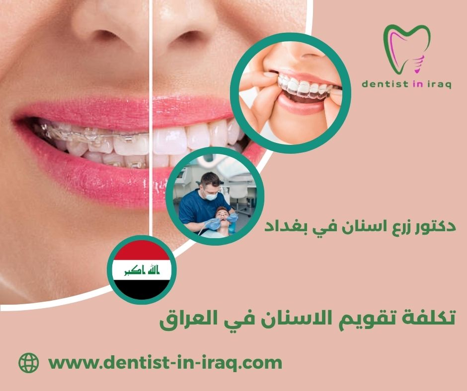 كم سعر تبييض الاسنان في العراق