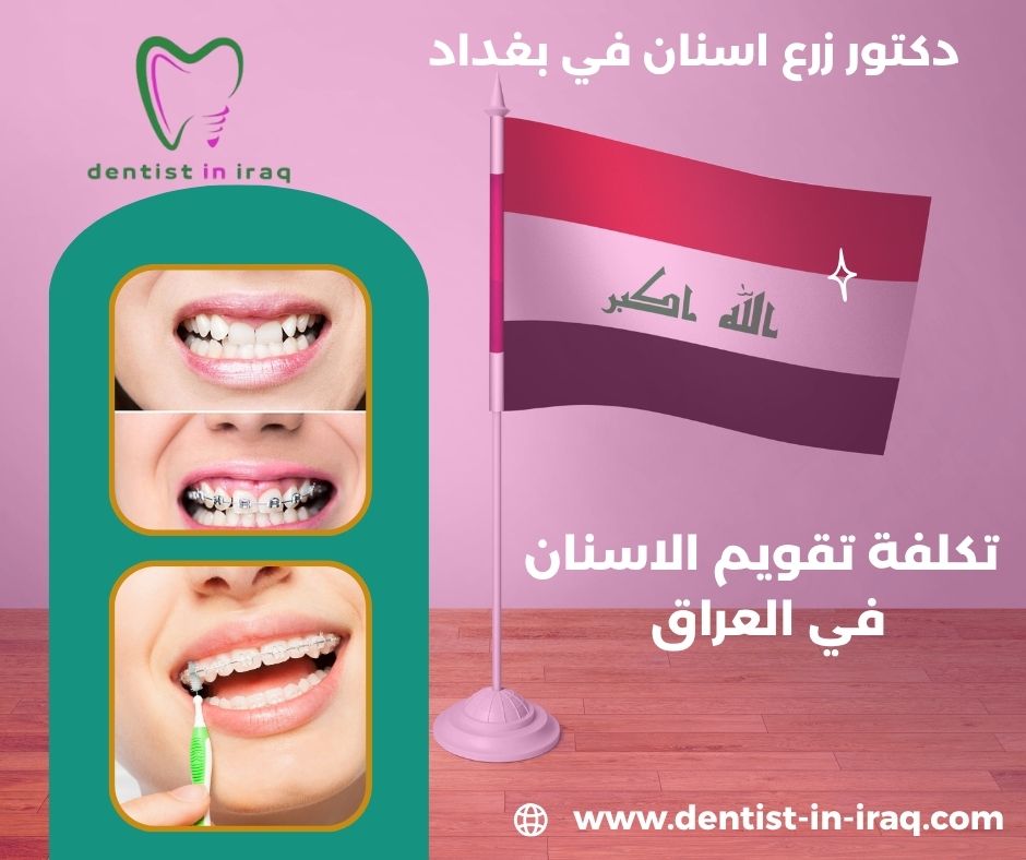 كم تكلفة زراعة الاسنان في العراق