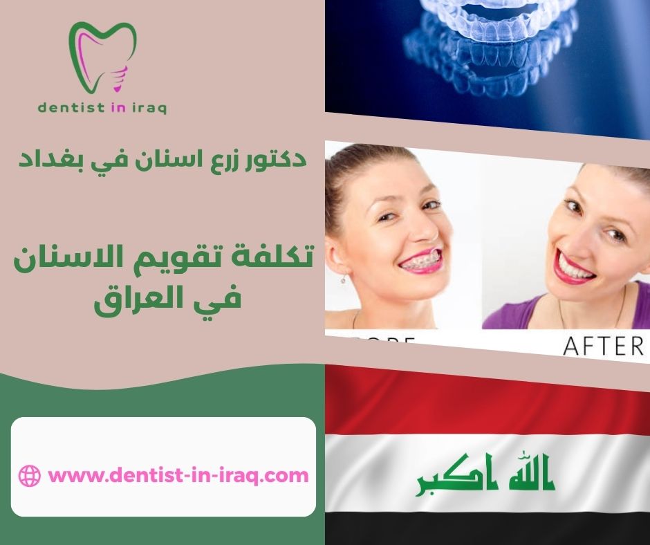 سعر تغليف الاسنان في العراق