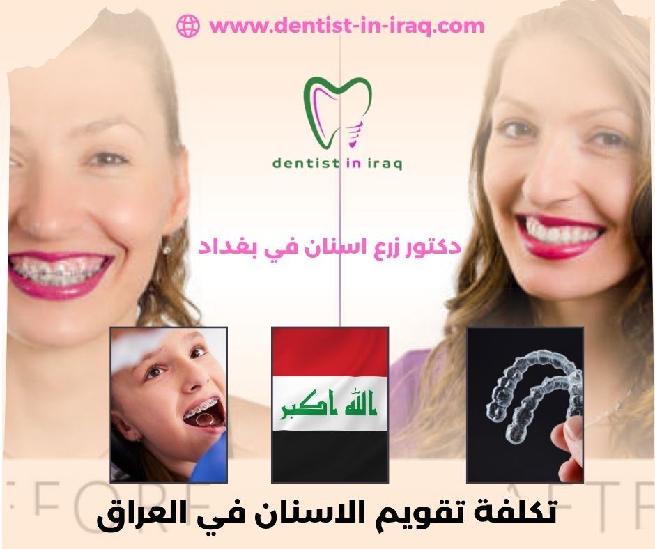 تكلفة تقويم الاسنان في العراق