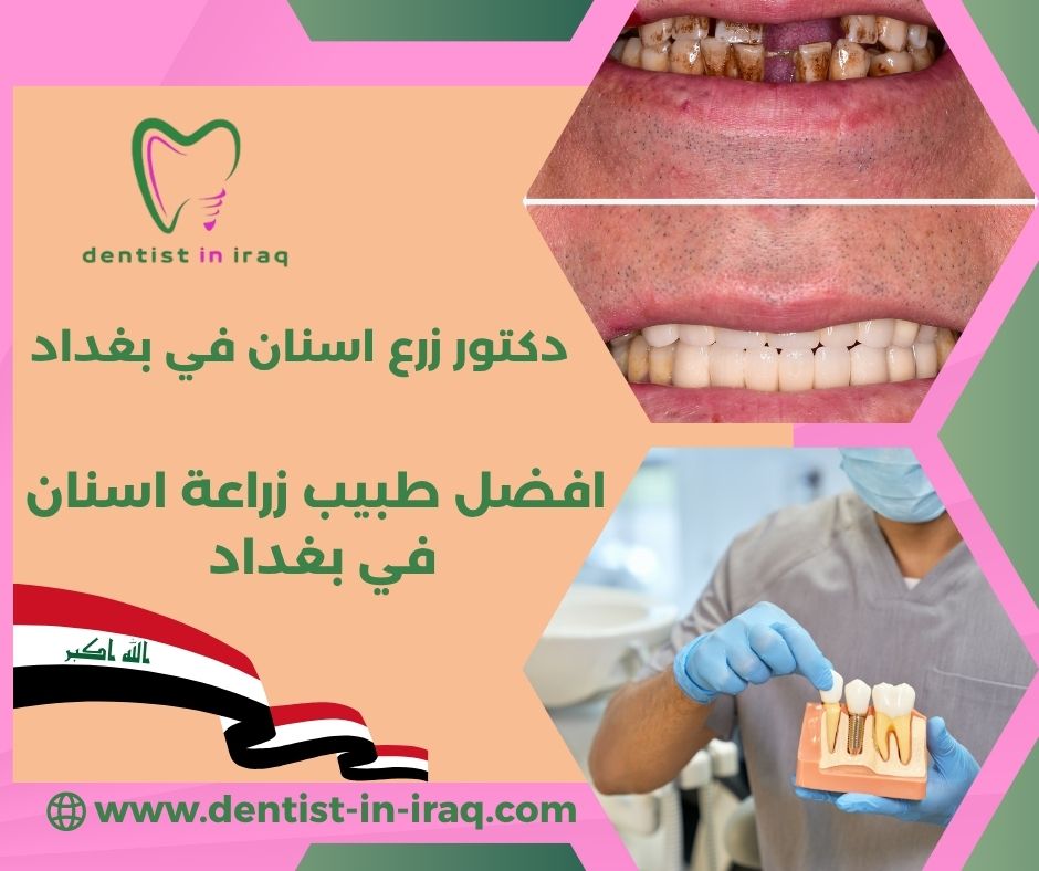 افضل طبيب زراعة اسنان في بغداد
