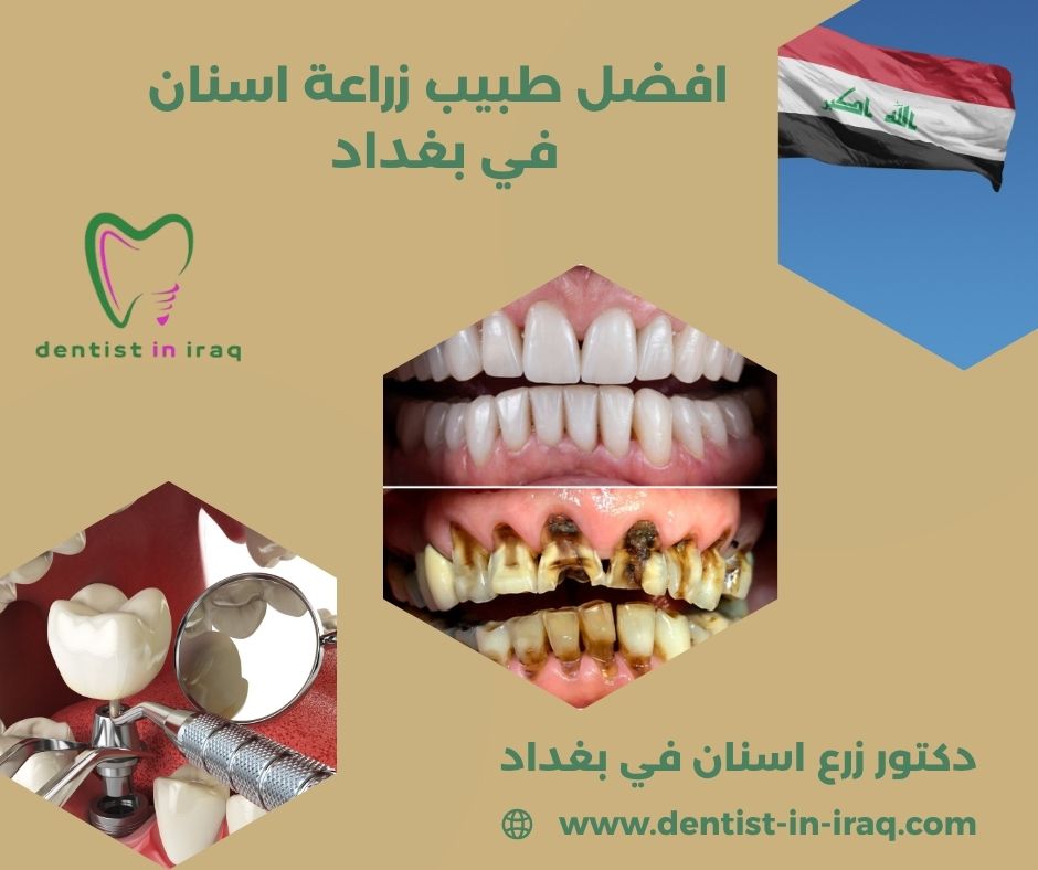 سعر تقويم الاسنان العراق