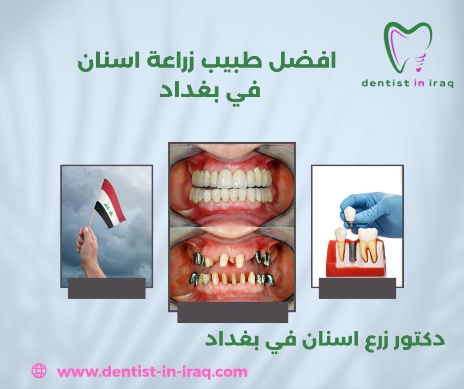 اسعار تقويم الاسنان في العراق