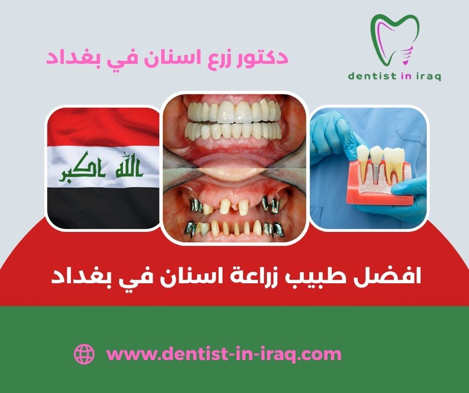 أنواع زراعة الأسنان وأسعارها