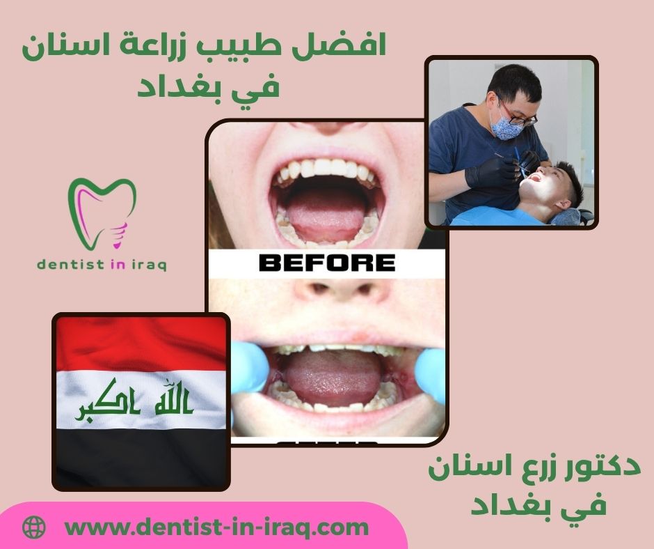 زراعة الاسنان في العراق