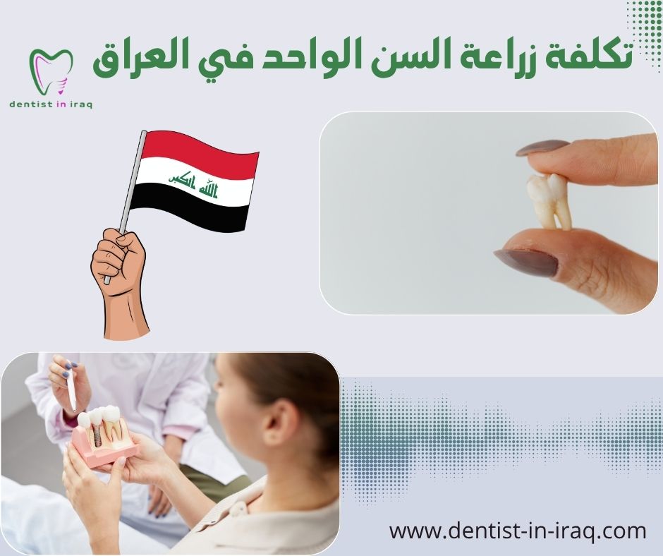 تكلفة زراعة السن الواحد في العراق