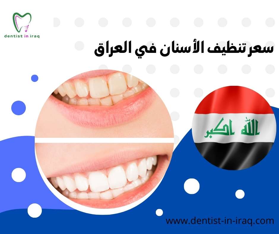 سعر تنظيف الأسنان في العراق