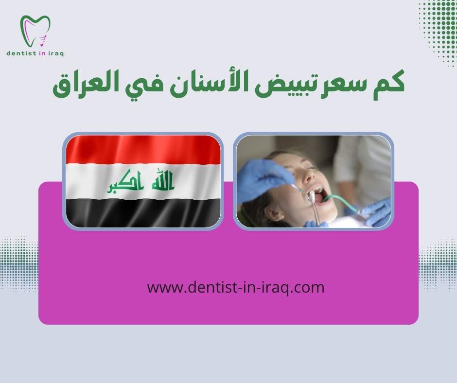 كم سعر تبييض الأسنان في العراق