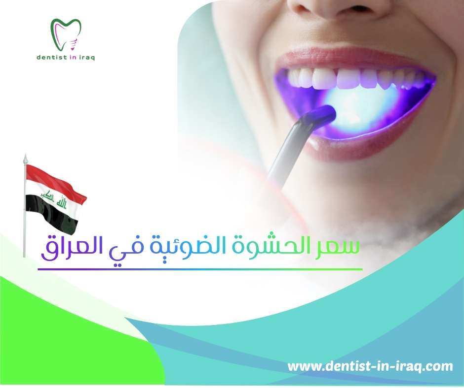 سعر الحشوة الضوئية في العراق