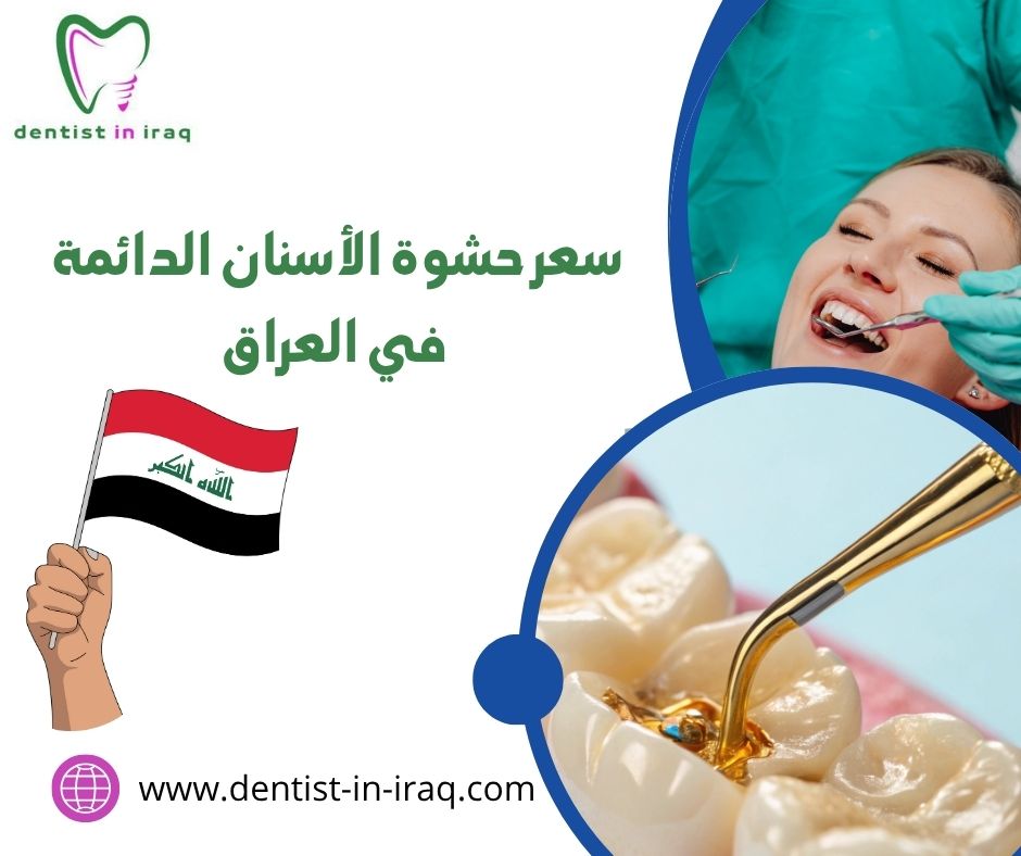 سعر حشوة الأسنان الدائمة في العراق