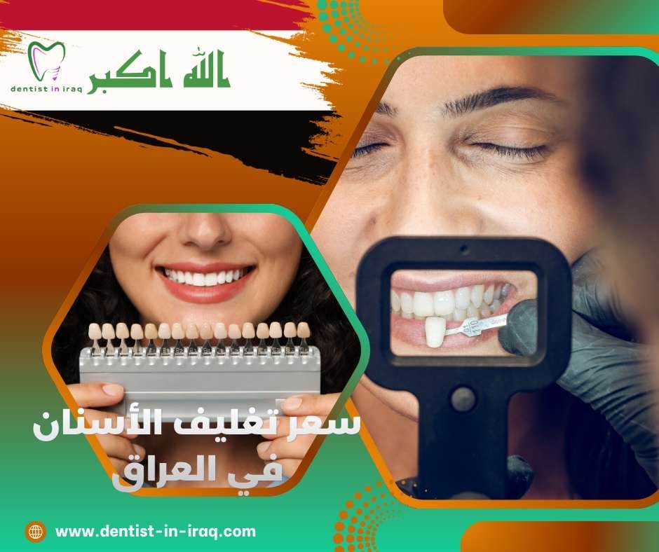 سعر تغليف الأسنان في العراق